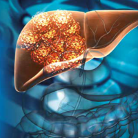 COP_EPATOCARCINOMA COP_EPATOCARCINOMA